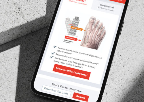 Alt text: "Phone displaying a website about Lapiplasty, a surgical procedure for bunion correction, with images and information."